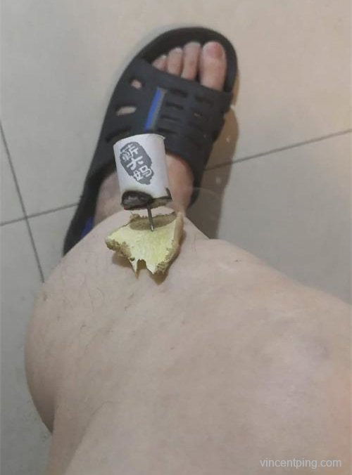 温针灸足三里